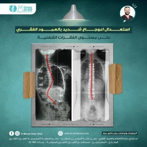 علاج الفقرات القطنية اسفل الظهر - دكتور مراد عمر