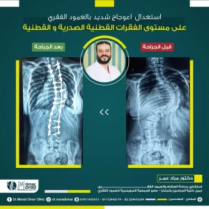 علاج الفقرات القطنية اسفل الظهر - دكتور مراد عمر