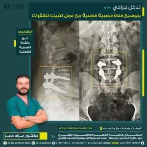 تكلفة عملية توسيع القناة العصبية