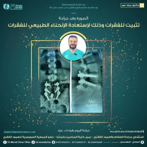 مدة الشفاء من عملية تثبيت الفقرات - دكتور مراد عمر