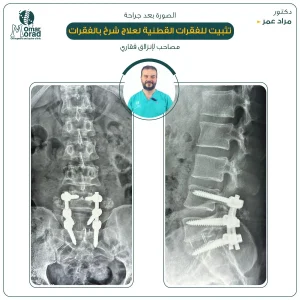 مدة الشفاء من عملية تثبيت الفقرات - دكتور مراد عمر