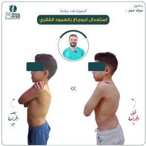 تكلفة عملية تعديل اعوجاج العمود الفقري - دكتور مراد عمر