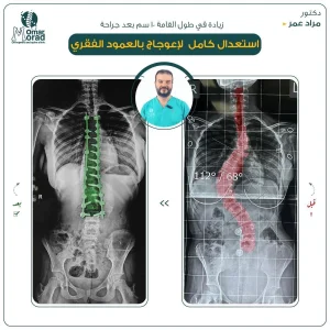 نسبة نجاح عملية اعوجاج العمود الفقري - دكتور مراد عمر