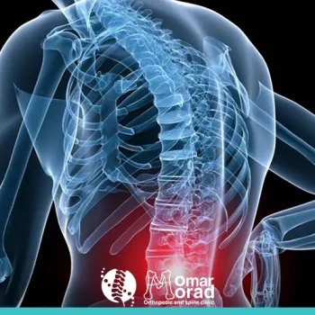 اعوجاج العمود الفقري اسفل الظهر