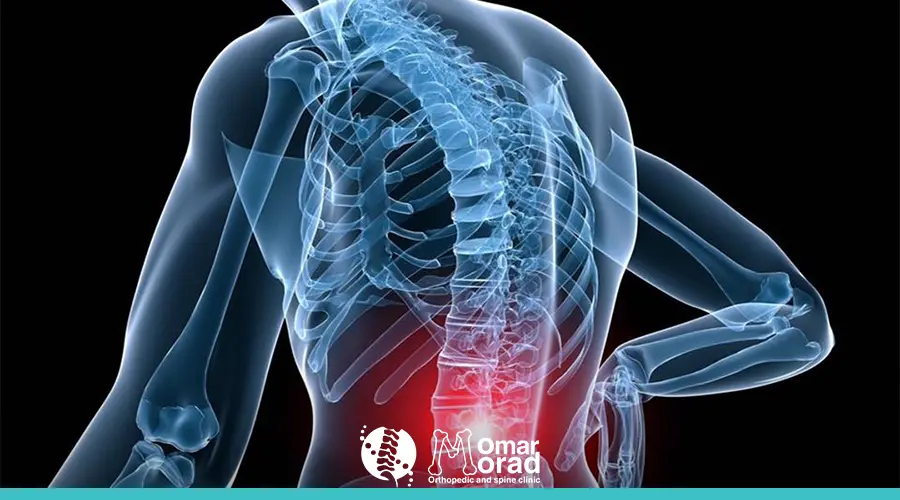 اعوجاج العمود الفقري اسفل الظهر​