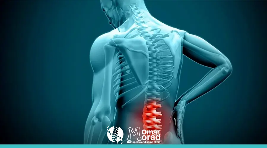انزلاق غضروفي في الرقبة