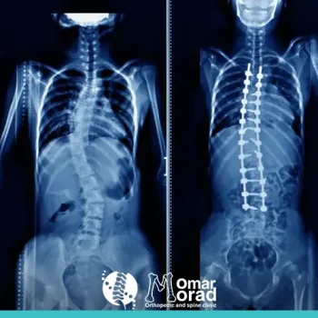 حالات اعوجاج العمود الفقري: الأسباب، التشخيص والعلاج
