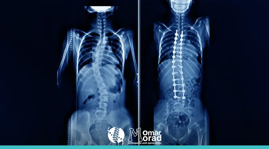 حالات اعوجاج العمود الفقري​: الأسباب، التشخيص والعلاج