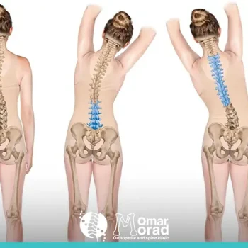 علاج اعوجاج العمود الفقري عند الكبار