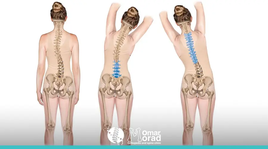 علاج اعوجاج العمود الفقري عند الكبار​