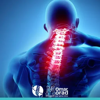 علاج الانزلاق الغضروفي في الرقبة
