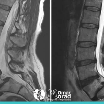 الانزلاق الفقاري من الدرجة الاولى