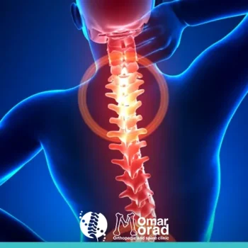 الجنف عند الشباب