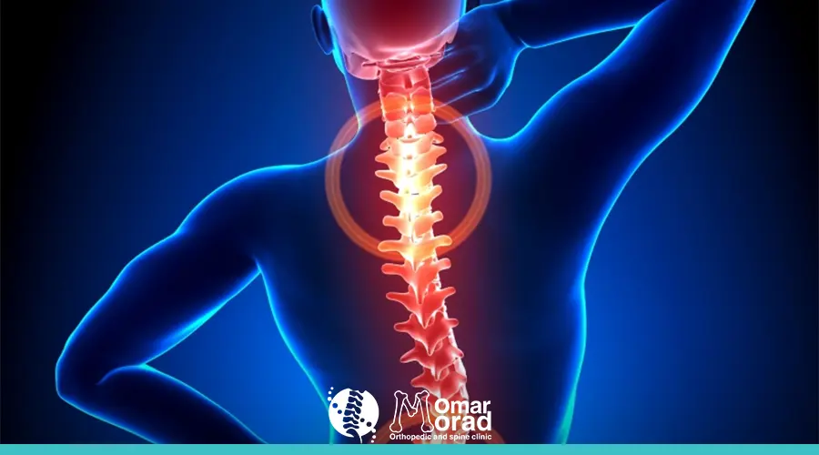 الجنف عند الشباب