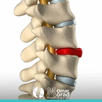 الفرق بين الغضروف والانزلاق الغضروفى