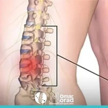 انزلاق غضروفي في الظهر