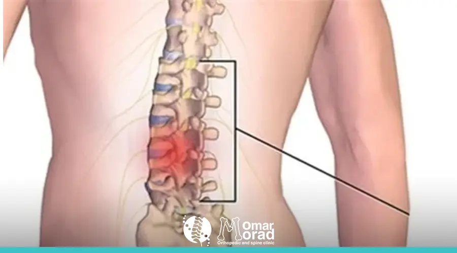 انزلاق غضروفي في الظهر