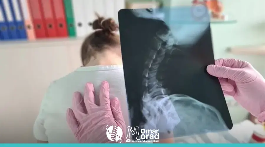 علاج انحناء الظهر عند الفتيات