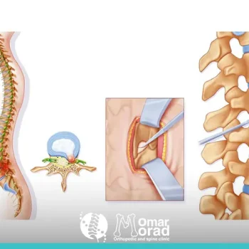 ما هو ديسك الرقبه؟ وكيفية التعامل معه بفعالية