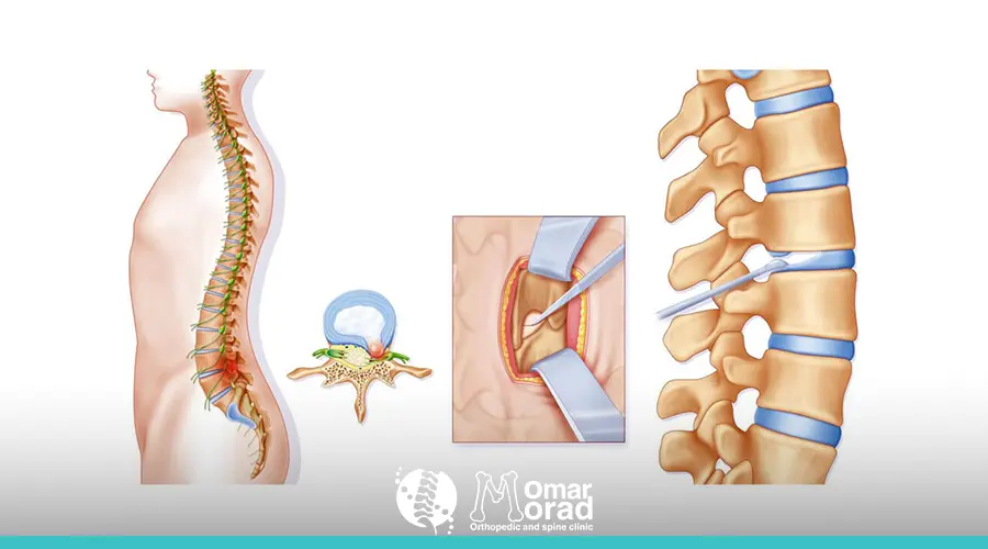 ما هو ديسك الرقبه؟ وكيفية التعامل معه بفعالية
