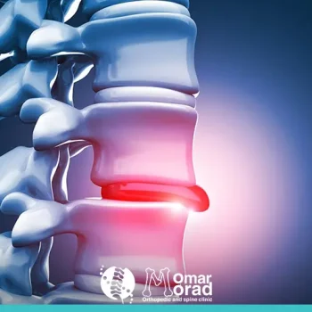 معنى انزلاق غضروفي