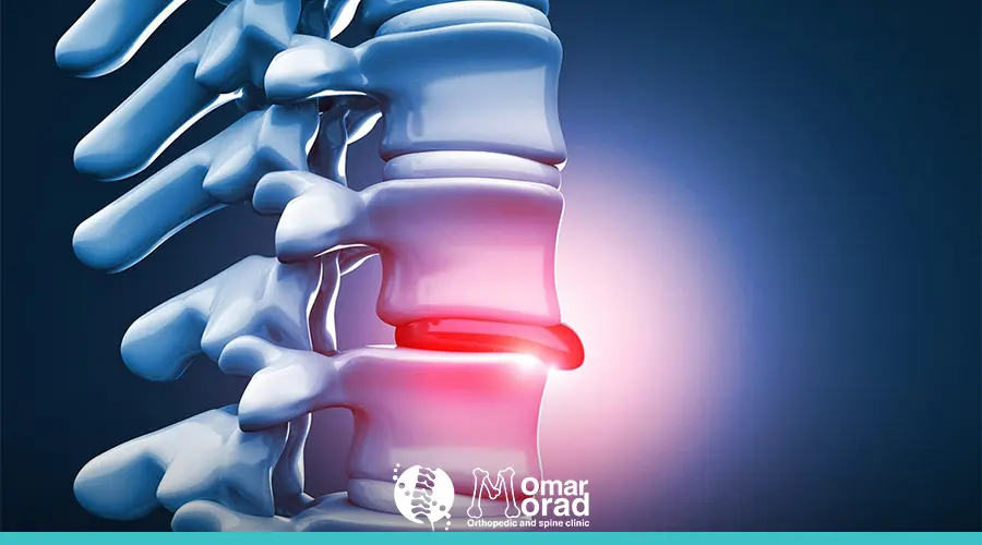 معنى انزلاق غضروفي