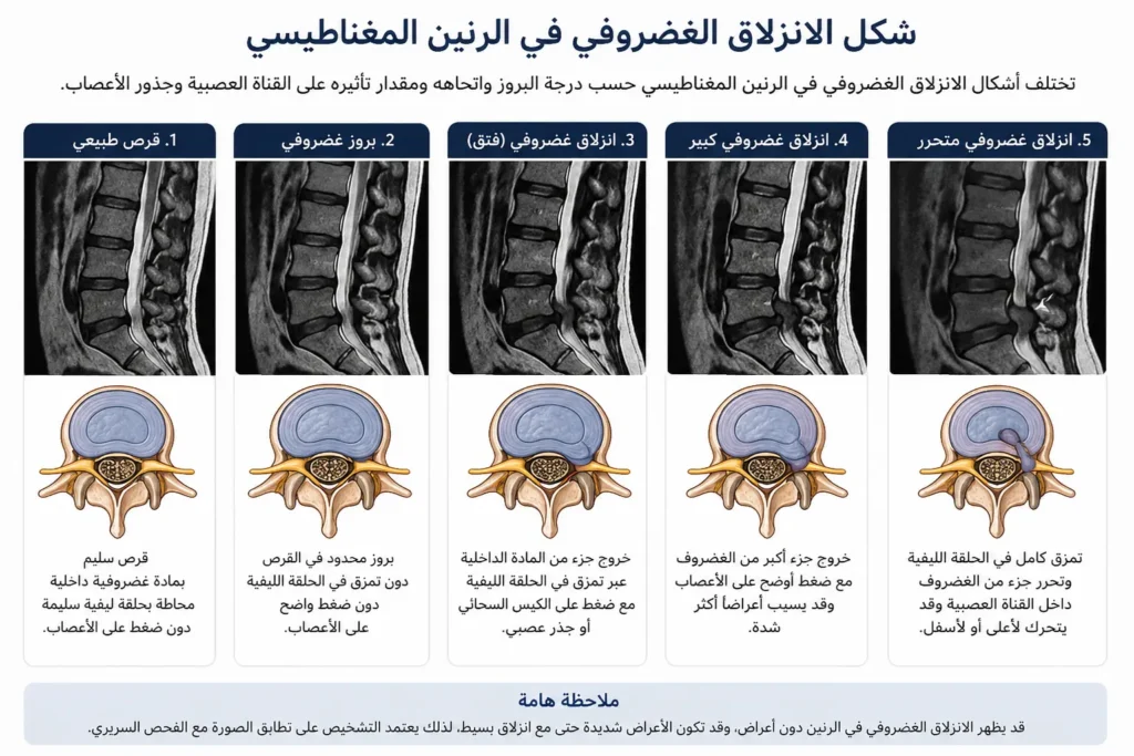 شكل الانزلاق الغضروفي في الرنين المغناطيسي