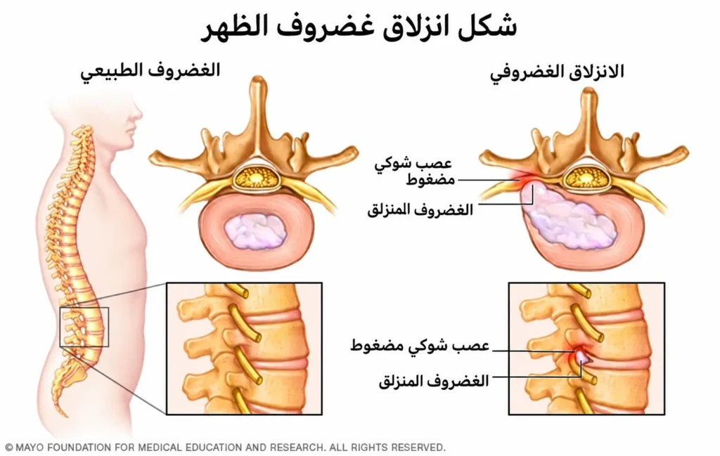 انزلاق غضروفي في الظهر