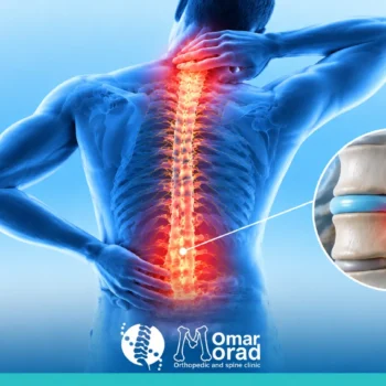 أعراض انضغاط الحبل الشوكي: العلامات المبكرة وطرق العلاج