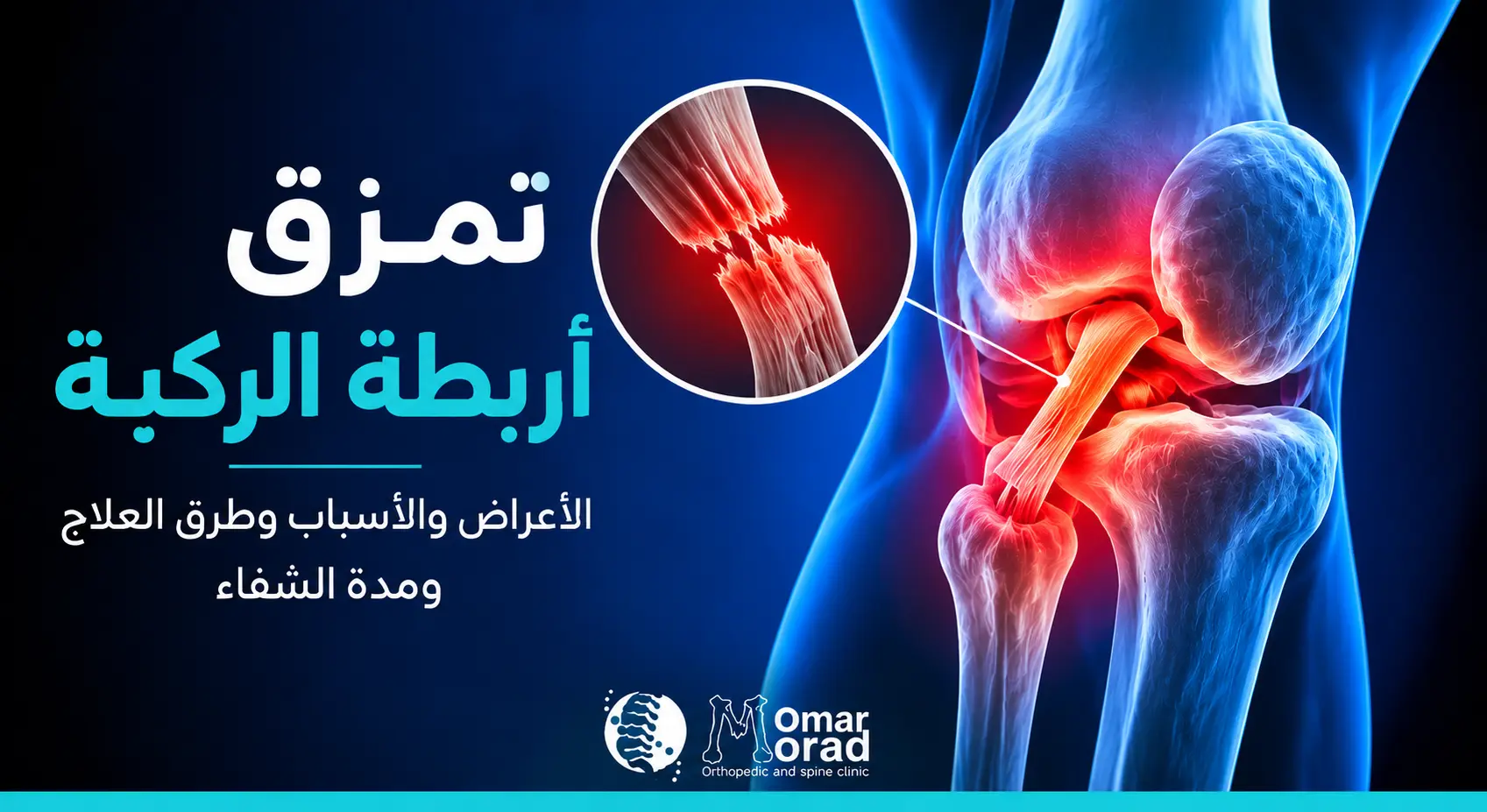 تمزق اربطة الركبة: الأعراض والأسباب وطرق العلاج ومدة الشفاء