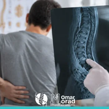 أعراض ورم العمود الفقري والعلامات المبكرة التي تستدعي الفحص